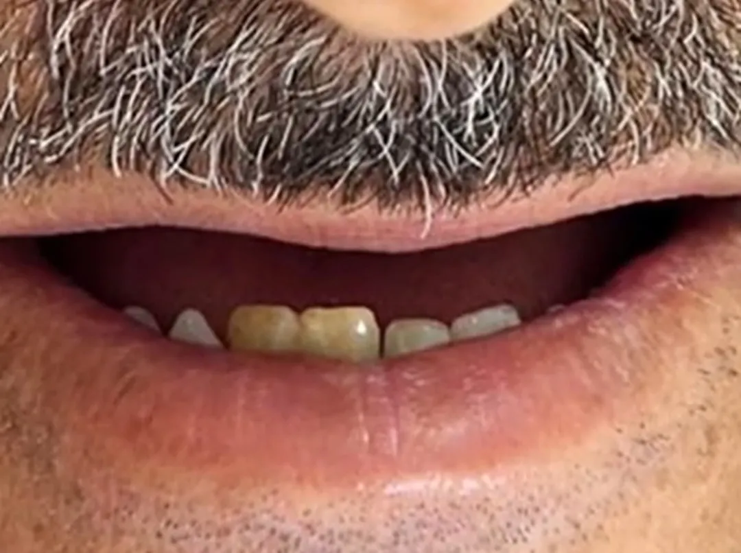 Antes: paciente com dentes perdidos antes e com sorriso fixo depois do tratamento com carga imediata