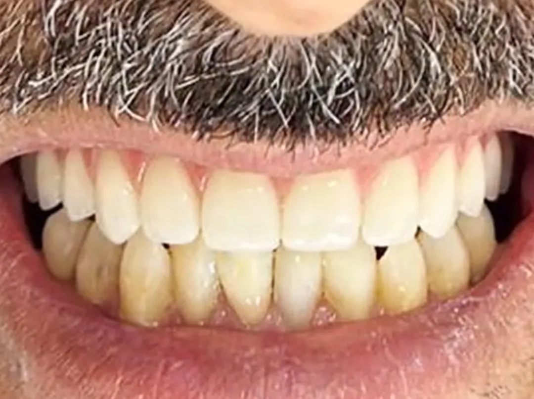 Sorriso de paciente da Sorria Nepomuceno após tratamento com carga imediata