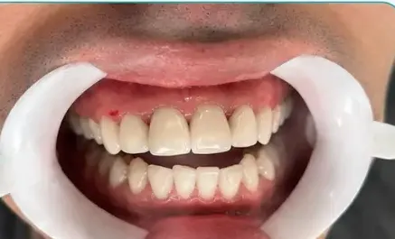 Dentes de paciente após facetas em resina na Sorria Nepomuceno
