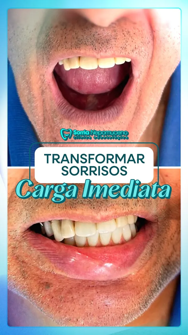 Transformação com carga imediata, antes e depois