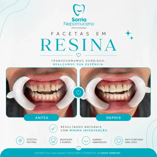 Arte sobre facetas em resina com fotos de antes e depois