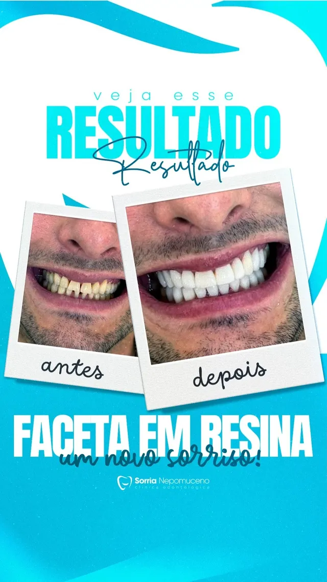 Antes e depois de facetas em resina publicado pela clínica
